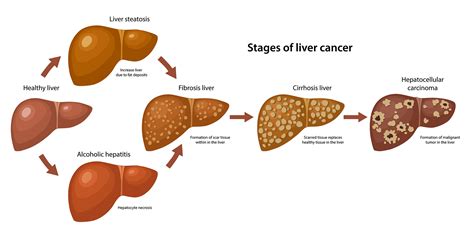 Stages of Liver Cancer | CyberKnife Treatment Center Miami