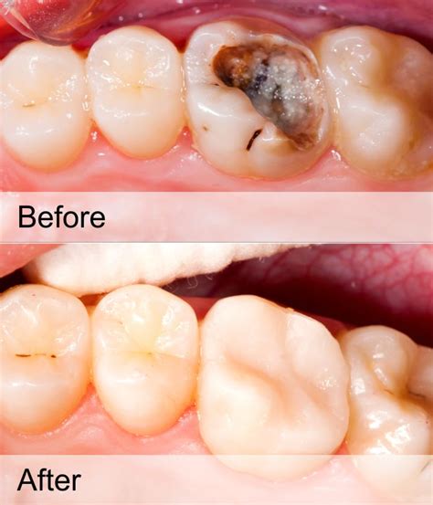 TOOTH CAVITY FILLING TREATMENT - MATRIX DENTAL AND SKIN LOUNGE