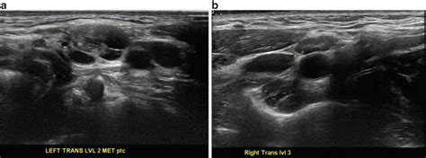 Normal Cervical Lymph Node Appearance and Anatomic Landmarks in Neck ...