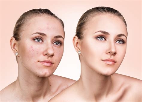 The Skin Before and after Acne Removal by the Experts – The WoW Style