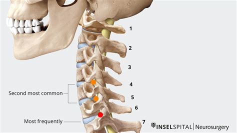 Herniated Cervical Disc