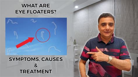 What Are Eye Floaters: Symptoms, Causes, and Treatment - YouTube