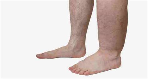 5 early warning signs and symptoms of elephantiasis | TheHealthSite.com