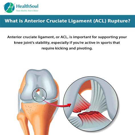 Anterior Cruciate Ligament (ACL) Rupture: Symptoms and Treatment ...