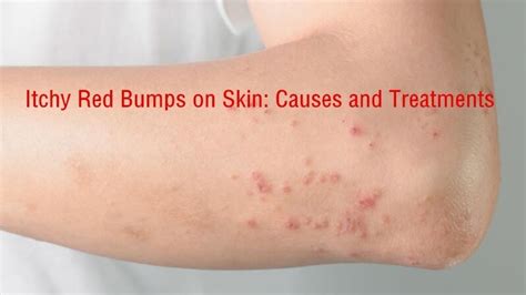 Itchy Red Bumps on Skin:12 Common Causes with Treatment