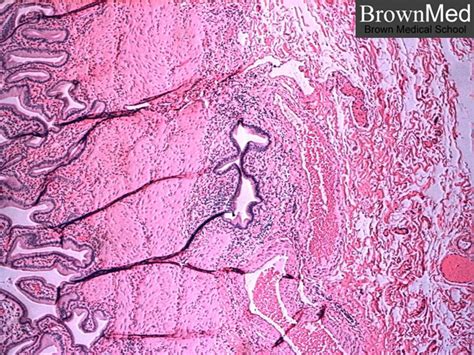 Chronic cholecystitis