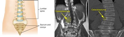 Osteoid Osteoma Spine