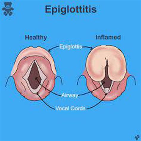 Epiglottitis - MEDizzy