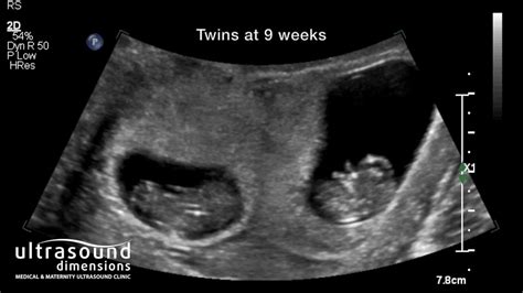 8 Week Ultrasound Fraternal Twins