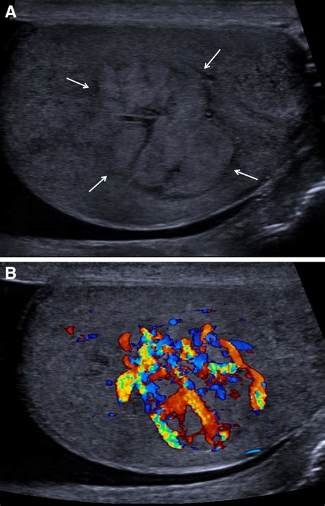 Multiparametric sonographic imaging of a capillary hemangioma of the ...