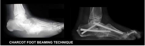 Charcot Foot Reconstruction