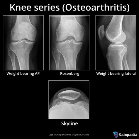 Arthritis Of The Knee - Aging The Healthy Way