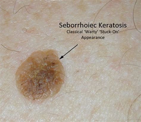 Seborrhoeic keratosis - MySkinDoctor