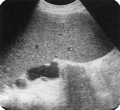 Ultrasound images of Splenomegaly - Radiology Imaging