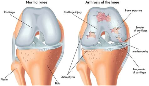 Osteoarthritis | Local Physio | Local Physio