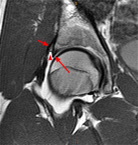 Acetabular Labral Tear - Radsource