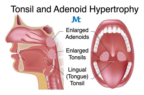 Tonsillectomy And Adenoidectomy Before And After