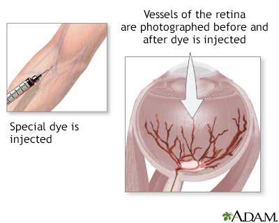 Fluorescein angiography Information | Mount Sinai - New York