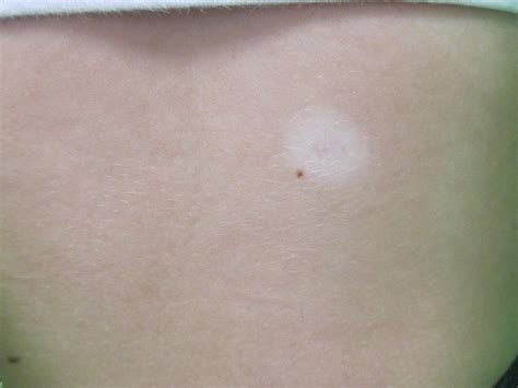 A Teenager With a Changing Mole on Her Back | Consultant360