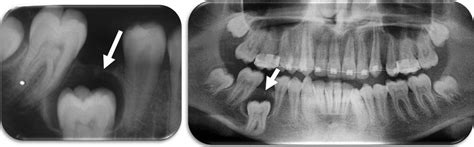 Dentigerous cyst: a common lesion in an uncommon site | BMJ Case Reports