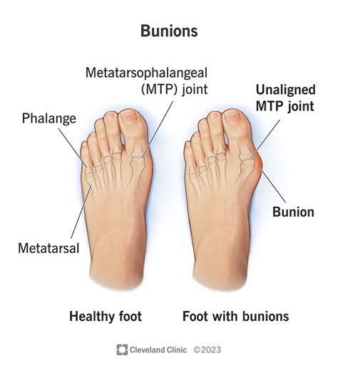 Bunions: Symptoms, Causes, & Treatment