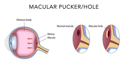 Macular Pucker (Macular Hole) - Eye Health Institute