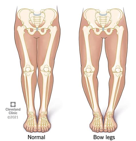 Risk Factors And Precautions For Bow Legs - Ask The Nurse Expert