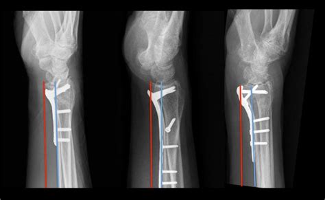 Complications in the Management of Distal Radius Fractures: How Do We ...