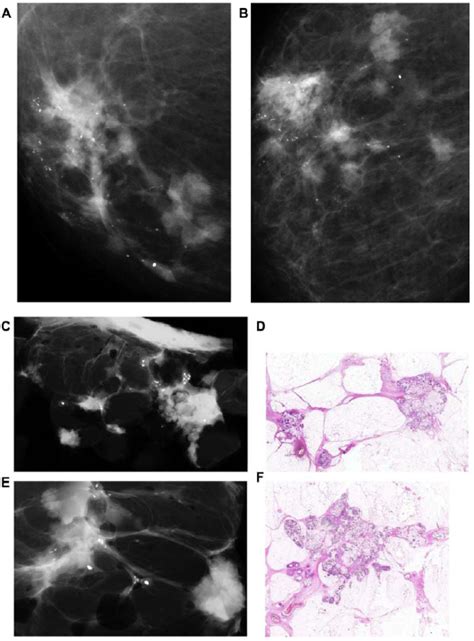 Microfocus magnification images on the craniocaudal and the ...