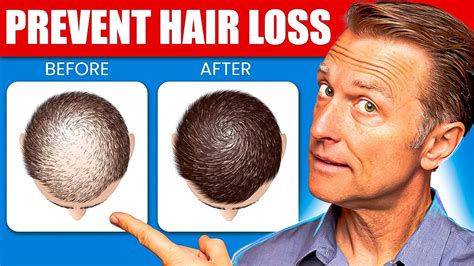 12 Proven Remedies to Prevent Hair Loss and Regrowth Regrow hair - YouTube