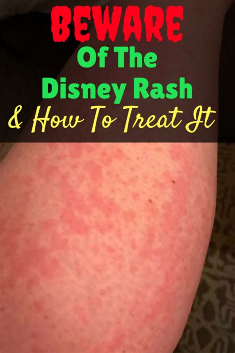 Beware Of The Disney Rash & How To Treat