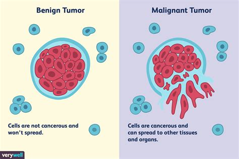 Differences Between a Malignant and Benign Tumor