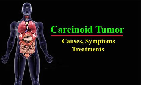 Carcinoid Syndrome - Tumor, Causes, Symptoms, Treatment