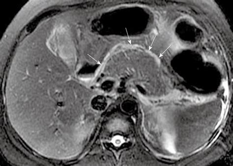 Magnetic resonance imaging for acute pancreatitis