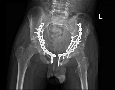 Pelvic Fracture Fixation