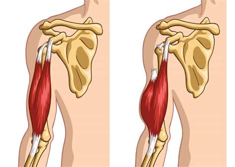 Biceps Tenodesis | Orthopedic Shoulder Surgeon | Manhattan, New York ...