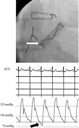 Occasional single-beat regurgitation observed with the new Medtronic ...