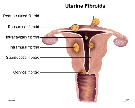 Leiomyoma (Fibroids) - USMLE Strike