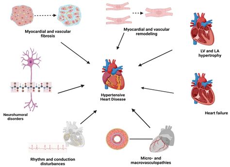 JCM | Free Full-Text | Hypertensive Heart Disease: A Narrative Review ...