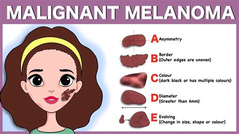 Melanoma Skin Cancer Symptoms And Signs