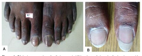 Figure 1 from Prevalence of nail changes in patients infected with HIV ...