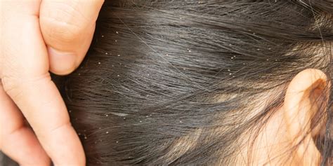 How To Tell The Difference Between Lice And Dandruff