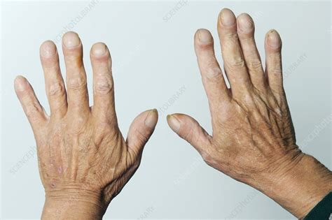 Clubbed fingernails - Stock Image - C010/3263 - Science Photo Library