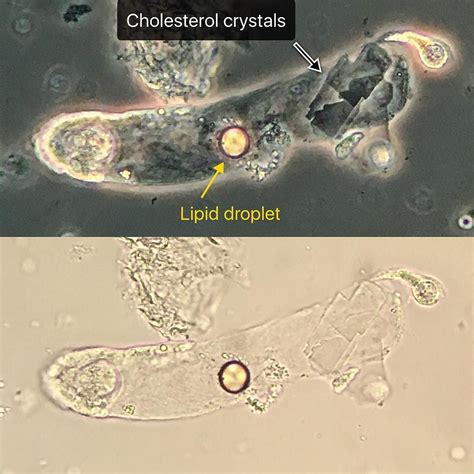 Cholesterol Crystals