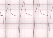 What is the treatment of idioventricular rhythm? - All About ...