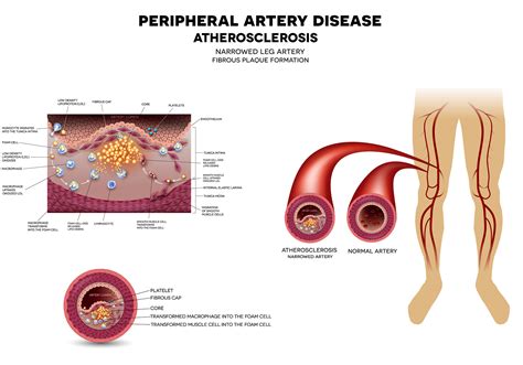 What is Peripheral Artery Disease (PAD)? - Imaging Center, Minimally ...