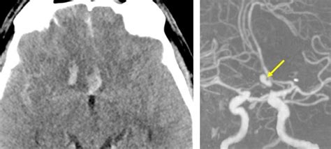 Ruptured ACOM aneurysm – Radiology Cases