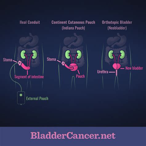 Urethra Bladder Surgery