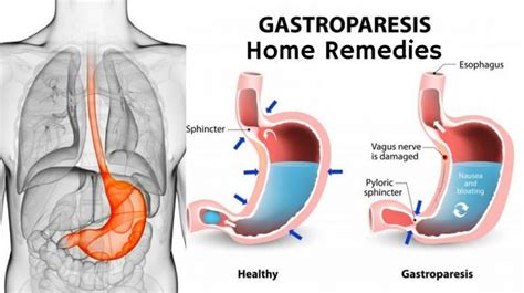 Home Remedies to Get Rid of Gastroparesis