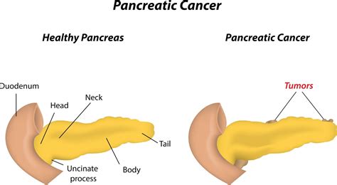 Laparoscopic Treatment : Purpose, Procedure & Recovery: Pancreatic ...